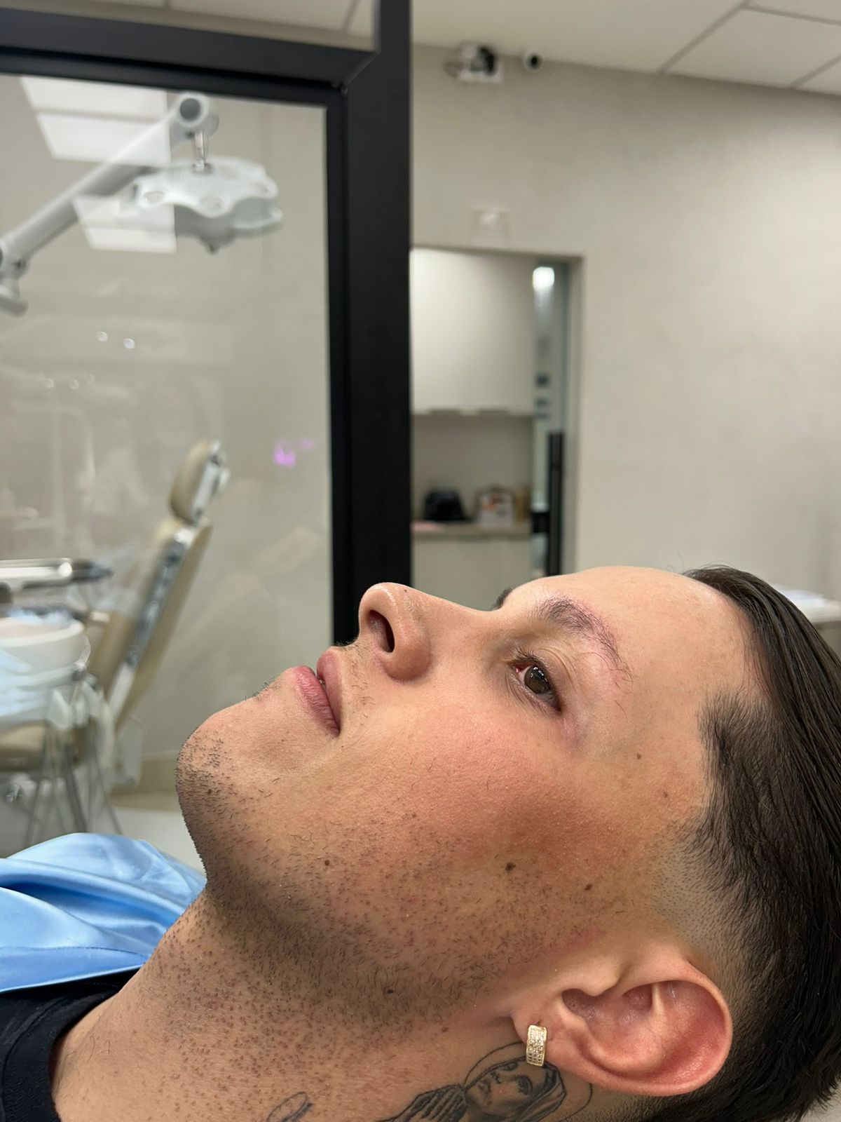 Antes — perfil masculino antes da harmonização